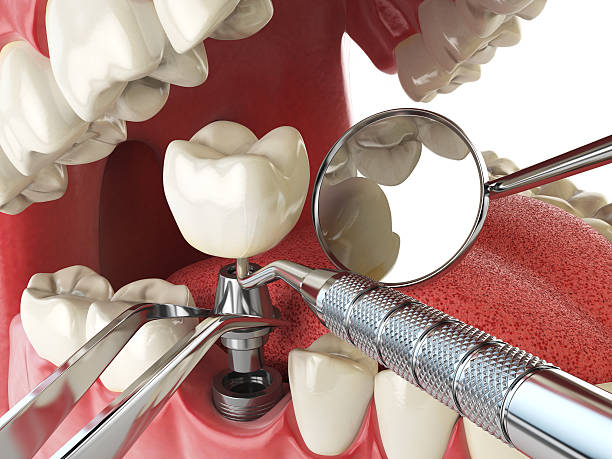 Best Emergency Tooth Extraction in Pataskala, OH